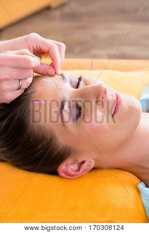 Therapist setting acupuncture needles on woman in course of acupuncture treatment