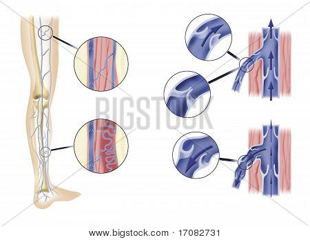 Bein-Arterie und Aorten-Ventile