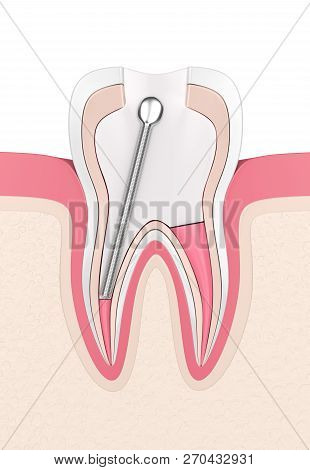 3D Render Of Tooth With Stainless Steel Dental Post And Filling