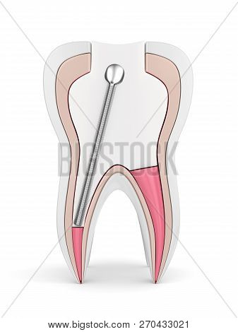 3D Render Of Tooth With Stainless Steel Dental Post And Filling