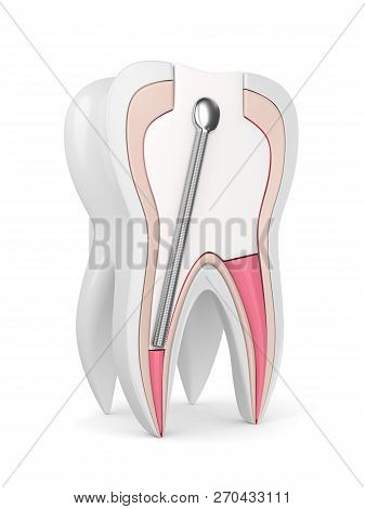 3D Render Of Tooth With Stainless Steel Dental Post And Filling