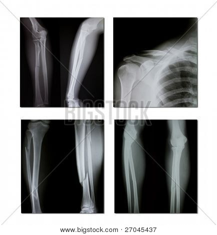 samling af x-ray (brækket skulder, brækket ben)