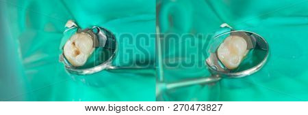 Human Teeth Close-up During Restoration Of Filling. The Concept Of Aesthetic Dentistry
