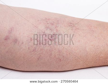 Vascular Marks On The Skin From Varicose Veins, Vascular Pattern On The Skin, Close-up, Phlebeurysm,