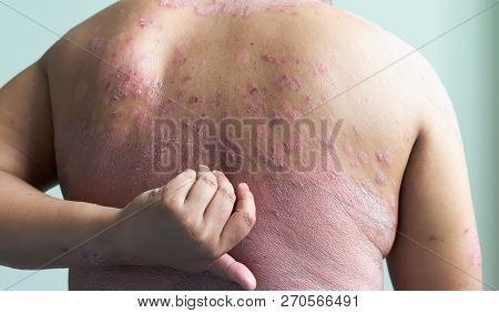 Patients Are Using Their Own Hands, Scratching Themselves Full Of Inflammatory Lesions. Diseases Cau