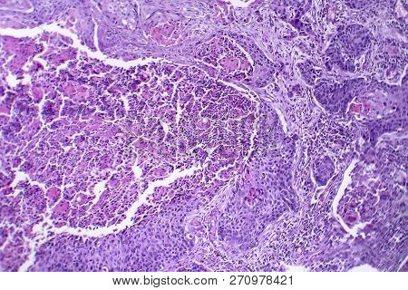 Squamous Cell Carcinoma Of The Lung, Light Micrograph, Photo Under Microscope