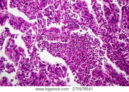 Histopathology Of Lung Cancer, Light Micrograph, Photo Under Microscope