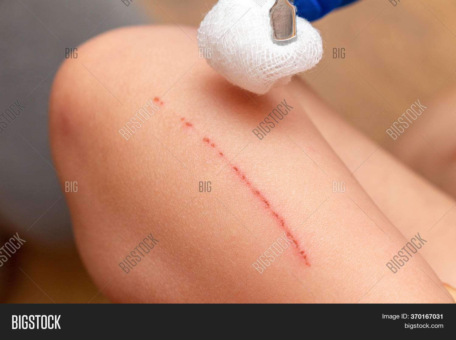 Treating Scratches On Image & Photo (Free Trial) | Bigstock