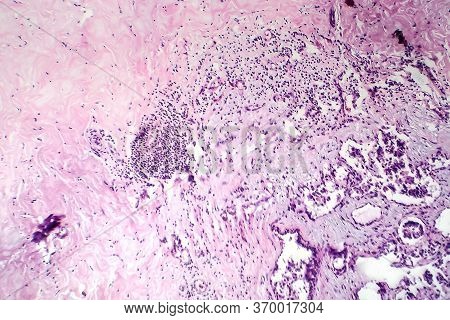 Breast Fibroadenosis, Light Micrograph, Photo Under Microscope. Common Benign Hyperplastic Process I
