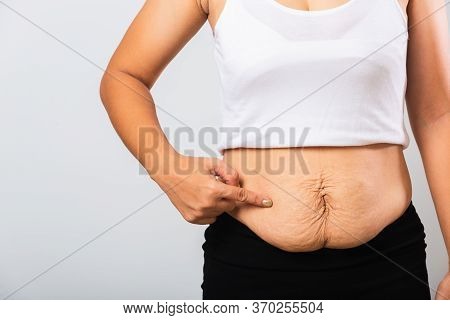 Close Up Of Asian Mother Woman Pointing Stretch Mark Loose Lower Abdomen Skin She Fat After Pregnanc
