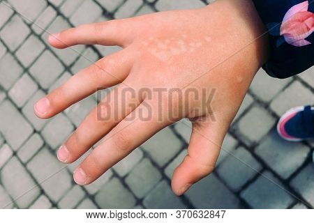 The Girl Burned Her Hand With Nettle Grass. Type Of Burn.