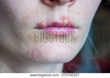 Herpes Disease On The Lips Of A Young Girl. Wounds From Herpes On The Lips Of A Person. Herpes Foci.
