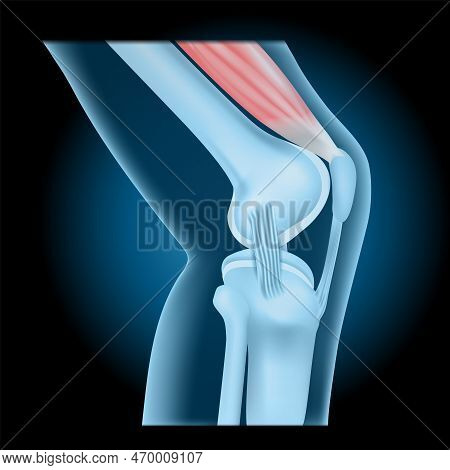 Knee Joint With Quadriceps. Side View Of Human Knee With Glowing Effect. Realistic Transparent Blue 