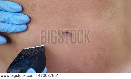 Close-up, Cosmetologist Female Hands In Gloves Haircut Body Hair Of A Naked Hairy Man, His Chest, To