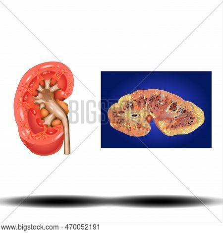 Kidney - Internal Organ, Kidney Stones. Renal Calculi, Nephrolithiasis Or Urolithiasis. Healthcare C