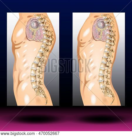 Spine Kyphosis -  A Forward Rounding Of The Back.
Hunchback (kyphosis) Usually Refers To An Abnormal
