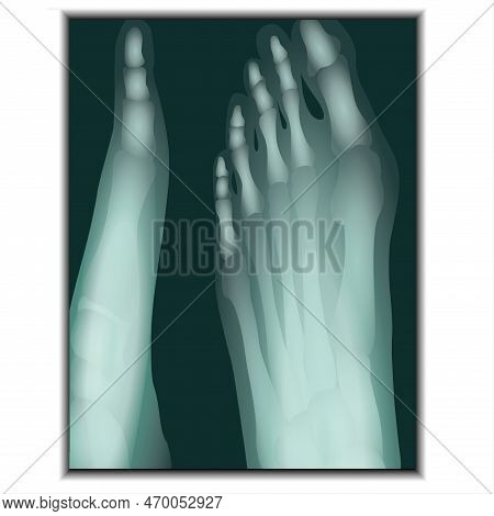 X-ray Of Foot - Navicular Bone, Cuboid Bone, Phalanges