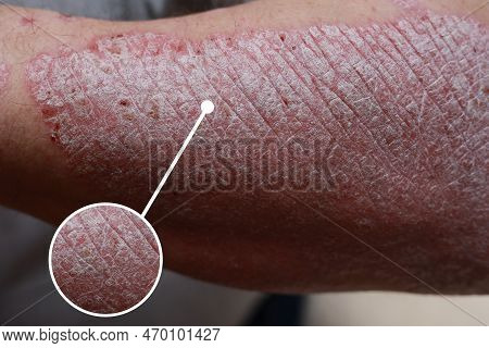 Macro Detailed Circles Magnification Of Psoriasis Skin, Autoimmune Disease That Affects The Skin Cau