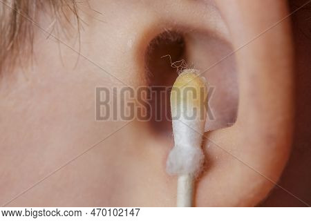 Cleaning The Ear With A Cotton Swab. The Process Of Cleaning The Ears Close-up, Yellow Cotton Swab W