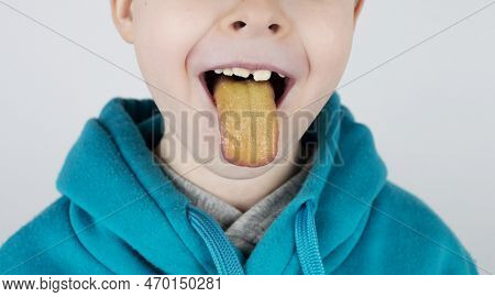 Blond Boy Has A Yellow Tongue. Painful Yellow Coating On The Mucous Membrane Of The Tongue. Diseases