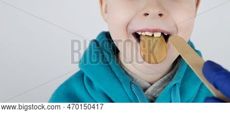 Blond Boy Has A Yellow Tongue. Painful Yellow Coating On The Mucous Membrane Of The Tongue. Diseases