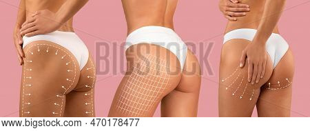 Close Up Young Diverse Women Hips In Bikini With Slim Body At Lines For Figure Shaping, Cellulite Pr