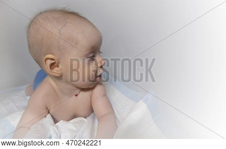 A Baby With A Hemangioma On His Neck Lies On A White Background. Banner With A Copy Space. Profile O