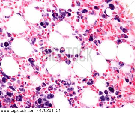 Macrophages Of An Inflammation Zone Heavily Marked With Trypan Blue A Vital Stain That Can Be Introd