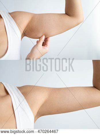 Shown Are The Before And After Results Of A Brachioplasty Operation, Also Called An Arm Lift.