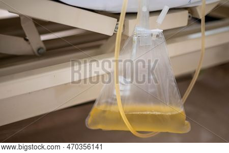 The Urine Or Pee Catheter Bag Hang Under Patient Bed In Hospital.