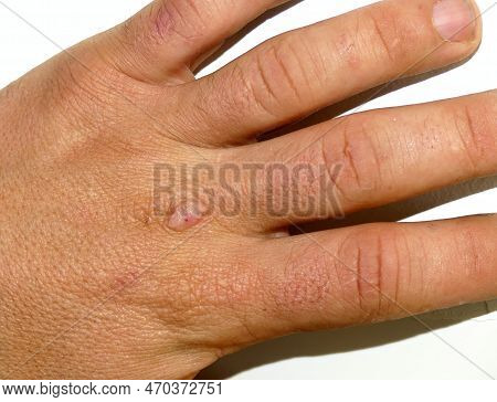 An Injury To A Knuckle Of The Hand From Removing A Scab From A Wound