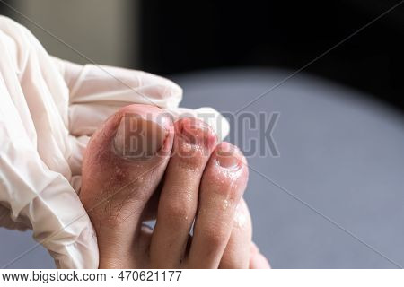 A Mans Toes Showing What Looks Like A Rash With Red Blotchy Skin. A Common Side Effect Of Covid-19 O