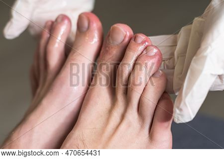 A Mans Toes Showing What Looks Like A Rash With Red Blotchy Skin. A Common Side Effect Of Covid-19 O
