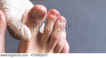 A White Man Holding His Toes, Showing What Looks Like A Rash With Red Blotchy Skin. A Common Side Ef