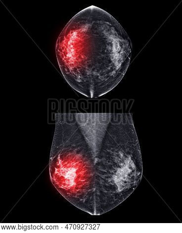X-ray Digital Mammogram Or Mammography Of Both Side Breast Cc View And Mlo  .