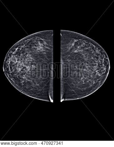X-ray Digital Mammogram Or Mammography Of Both Side Breast Standard Views Are Bilateral Craniocaudal