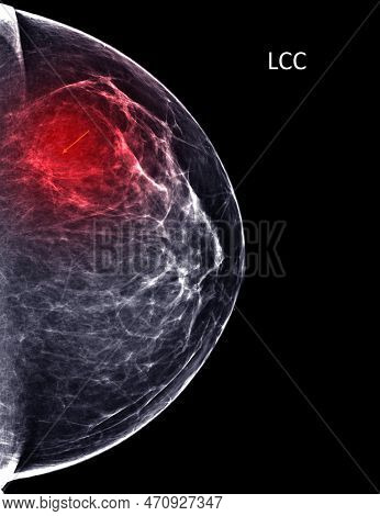 X-ray Digital Mammogram Or Mammography Of Both Side Breast Standard Views Are Bilateral Craniocaudal