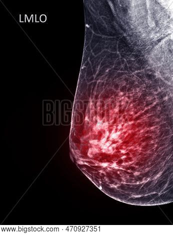 X-ray Digital Mammogram Or Mammography Of Both Side Breast Standard Views Are  Mediolateral Oblique