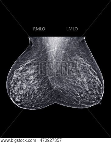 X-ray Digital Mammogram Or Mammography Of Both Side Breast Standard Views Are  Mediolateral Oblique