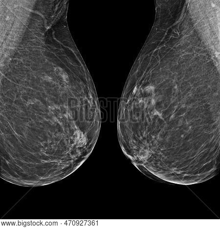 X-ray Digital Mammogram Or Mammography Of Both Side Breast Standard Views Are  Mediolateral Oblique
