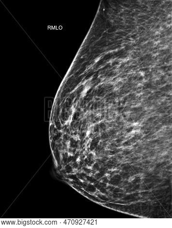 X-ray Digital Mammogram Or Mammography Of Both Side Breast Standard Views Are  Mediolateral Oblique