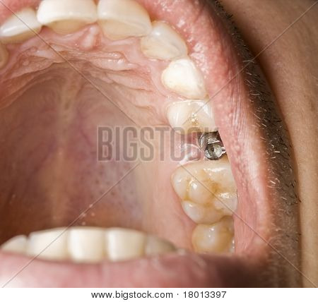 Diş Hekimliği Implant