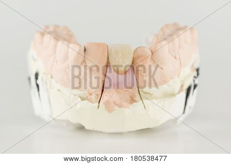 metal-ceramic dental crown is tried on an artificial model