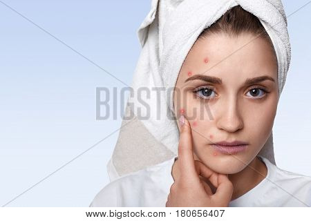 An isolated portrait of young woman having problem skin and pimple on her cheek wearing towel on her head having sad expression pointing at her pimple being in bathroom. Beauty and spa concept.
