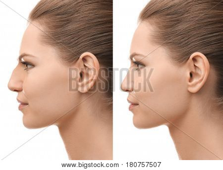 Young woman before and after rhinoplasty on white background. Plastic surgery concept