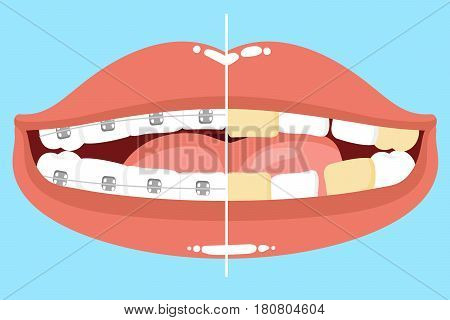 cute cartoon mouth with tooth wear braces before and after