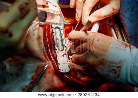 The Surgeon Makes An Surgeon In Operation Room With Blood Operation.