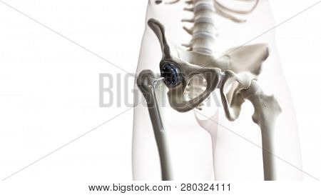 3d rendered medically accurate illustration of a hip replacement