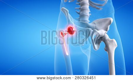3d rendered medically accurate illustration of a painful hip replacement