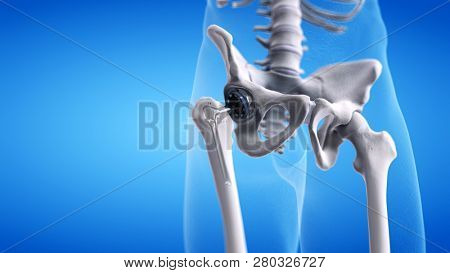 3d rendered medically accurate illustration of a hip replacement